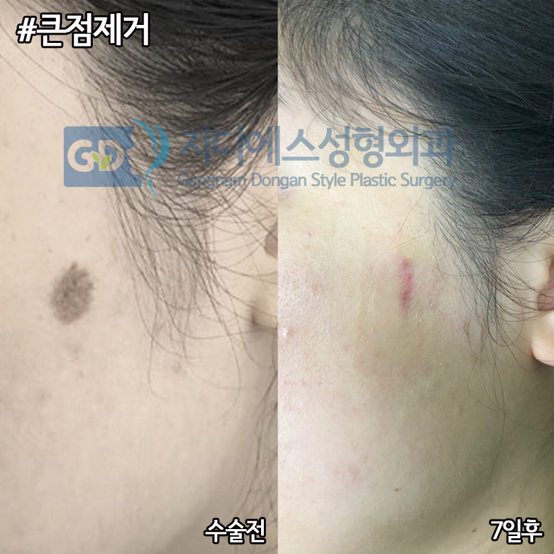 옆볼에 큰 점 치료 사례